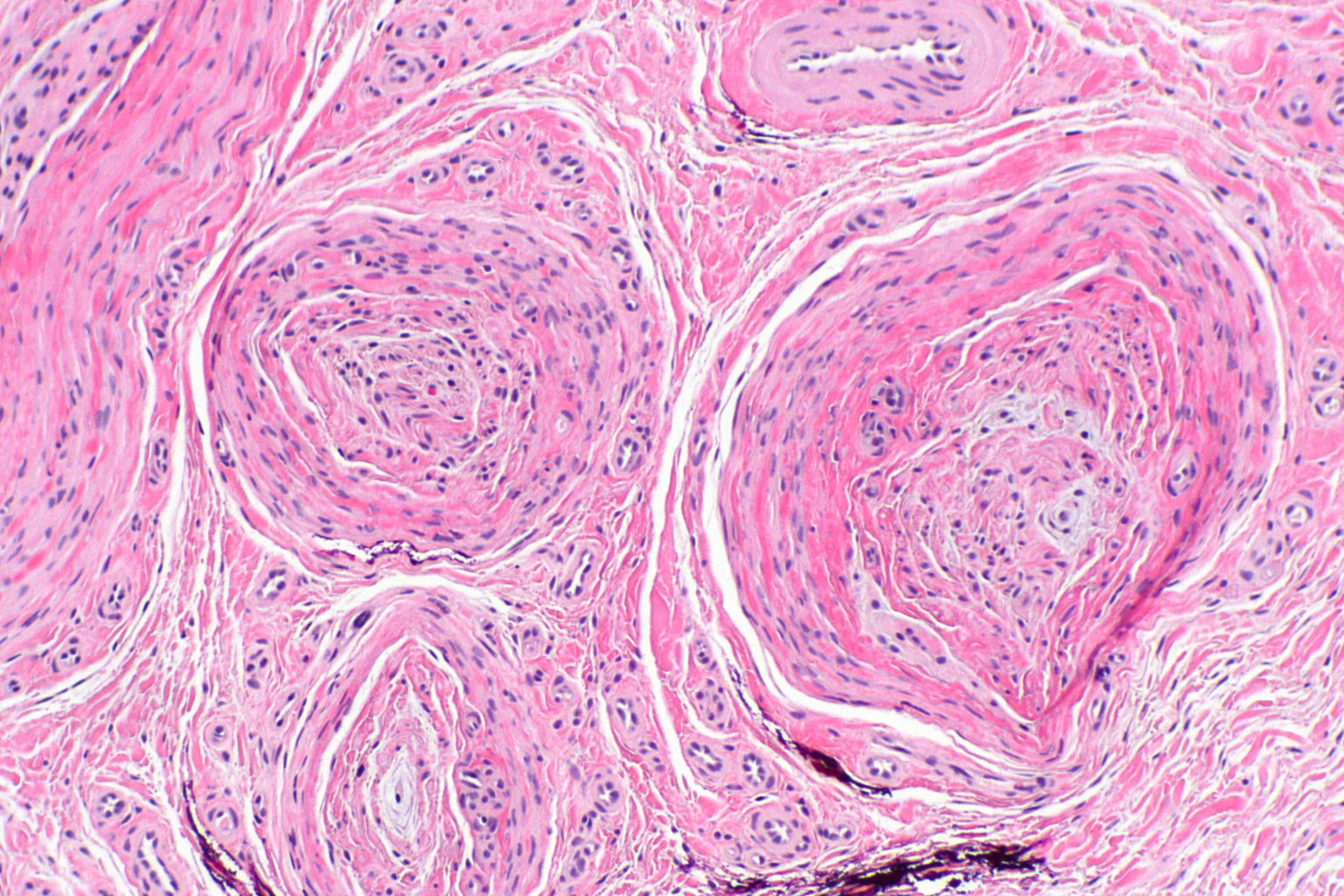 Neuroma de Morton y Laserterapia Terapia Láser Bioestimulante