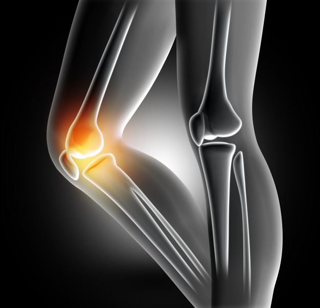 Por qué las mujeres tienen mayor predisposición a la lesión de rodilla