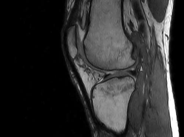 RM de rodilla en visión lateral que muestra el estado del cartílago rotuliano y tejido meniscal previo al tratamiento bioestimulante en Fisioláser.